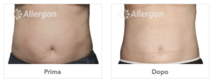 Trattamento Coolsculpting
