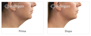 Trattamento Coolsculpting