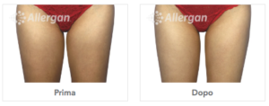 Trattamento Coolsculpting